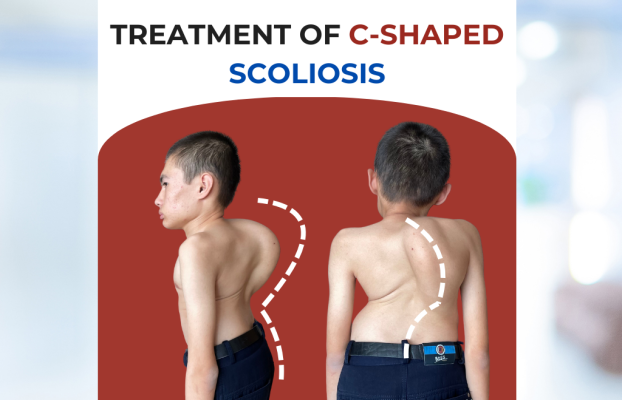 Лечение СКОЛИОЗА — история пациента