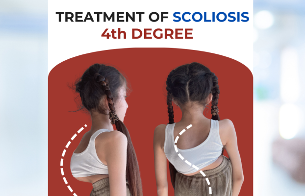 Лечение СКОЛИОЗА — история пациента